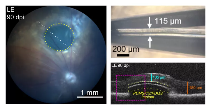 À gauche, fond de l’œil d’un rongeur 90 jours après l’implantation du dispositif photo-acoustique (ligne jaune pointillée) sous la rétine ; À droite en haut, photographie de l’implant photo-acoustique (vue latérale) : une structure tricouche (entre les deux flèches) avec une couche fine de suie encadrée de deux couches épaisses de polymère ; À droite en bas, coupe optique (OCT) de la rétine d’un rongeur 90 jours après l’implantation du dispositif photo-acoustique (coupe suivant la ligne blanche pointillée) 
