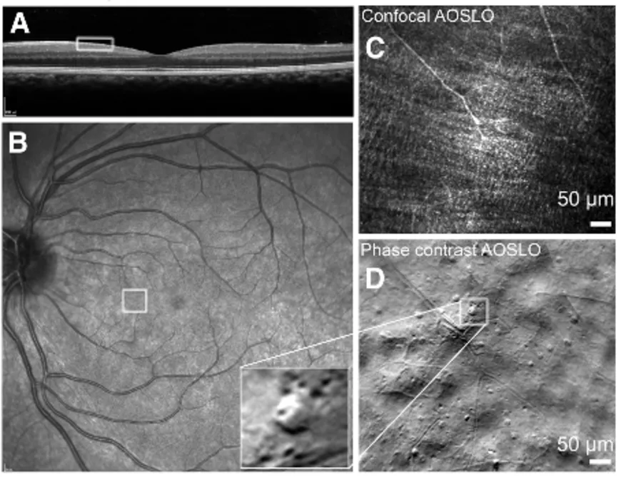 A) Coupe transverse de la rétine par OCT ; B) Fond de l’œil par ophtalmoscopie laser. La zone d’intérêt est délimitée par les carrés blancs ; C) Image de la zone d’intérêt avec une résolution cellulaire obtenue avec AOSLO à partir des rayons lumineux qui reviennent suivant l’axe du dispositif ; D) Image de la zone d’intérêt obtenue avec AOSLO à partir des rayons lumineux « hors axe ». Zoom sur une cellule immunitaire révélée grâce à la détection des rayons déviés par la cellule.