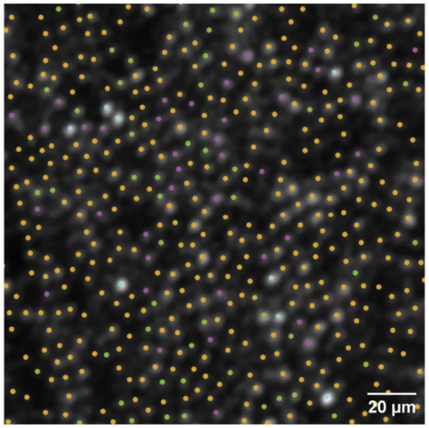 Mapping of the distribution of cones in the retina of a 24-year-old patient obtained from the measurement of the light intensity of each cone following a flash of green light. Two types of cones are visible: active cones, marked with pink and green dots; the cones inactive, marked with yellow dots. 