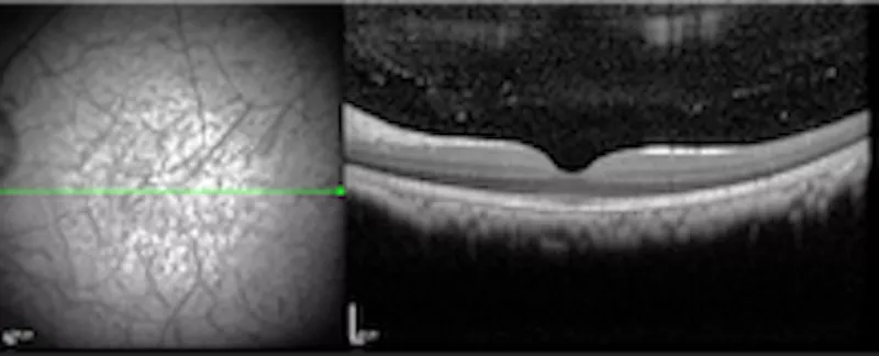 Imagerie injection intravitréenne améliorée
